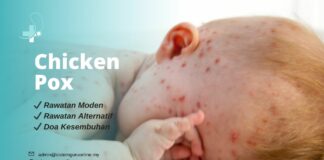 Gejala Chicken Pox yang Serius Pada Anak Anda Serta 5 Rawatan Alternatif Chicken Pox