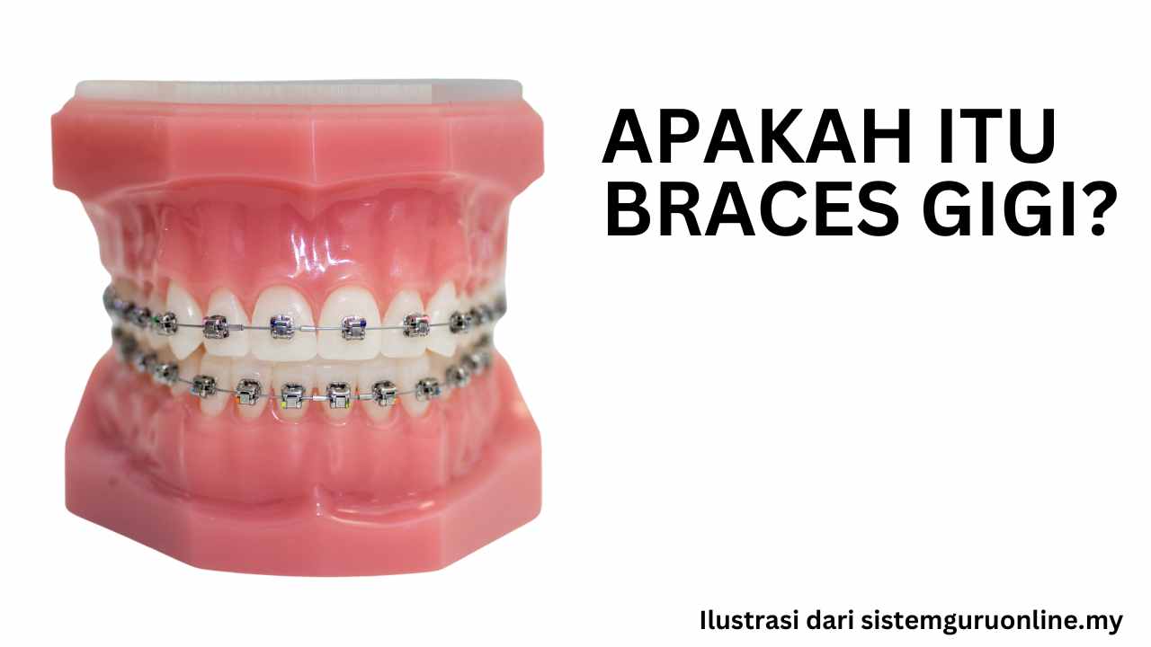 Prosedur Dan Harga Pakai Braces Gigi Dan Perkara Yang Anda Perlu Tahu