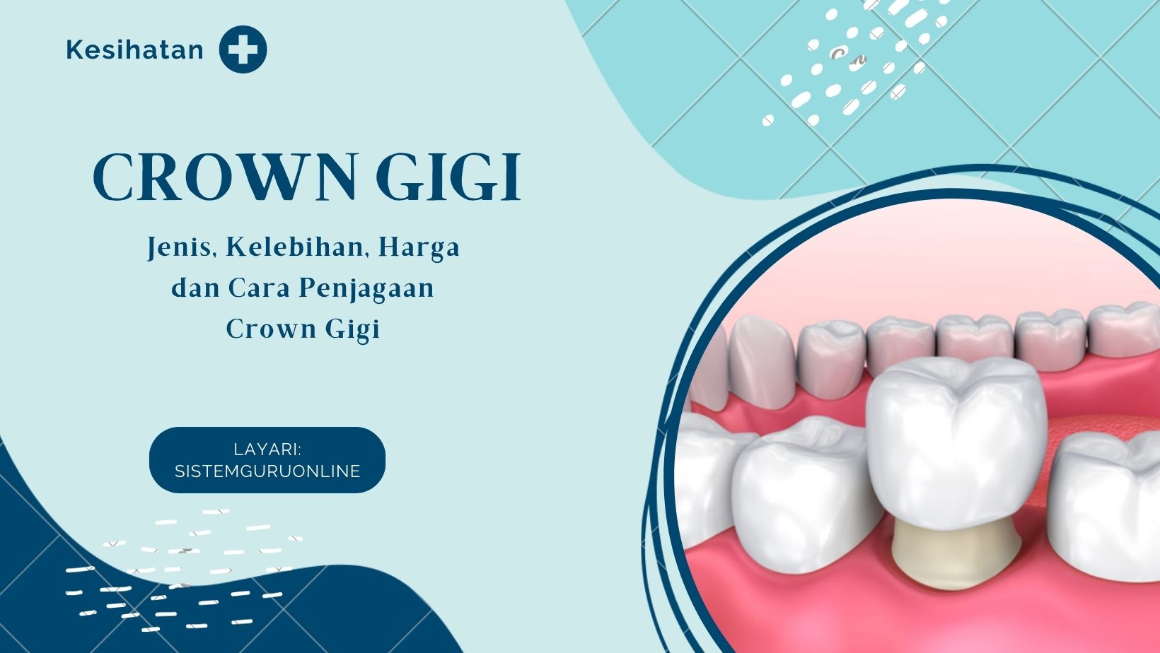Crown Gigi 6 Jenis, Kelebihan, Harga Dan Cara Penjagaan Crown Gigi
