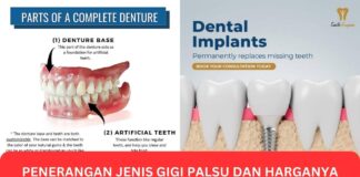 Penerangan Jenis Gigi Palsu dan Harganya