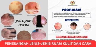 Penerangan Jenis-Jenis Ruam Kulit dan Cara Rawat Ruam Kulit Penerangan Jenis-Jenis Ruam Kulit dan Cara Rawat Ruam Kulit